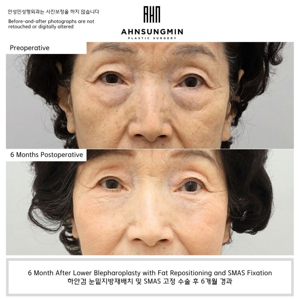 Lower blepharoplasty with fat repositioning and septal reinforcement in a patient in her 70s in Korea, showing natural volume preservation at 6 months postoperative