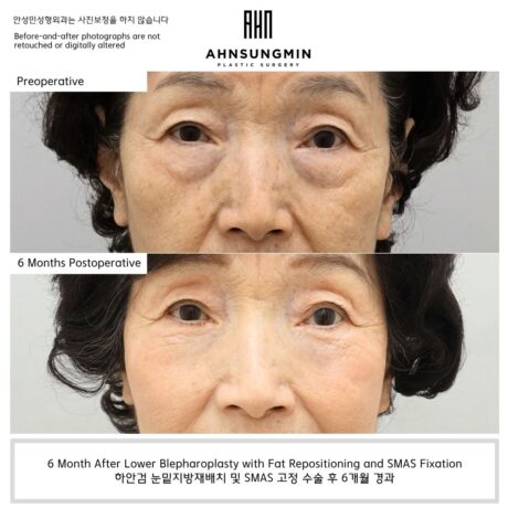 Lower Blepharoplasty in a Patient in Her 70s: Why Natural Structural Support Matters More Than Aggressive Tightening.