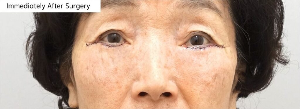 Immediately after lower blepharoplasty with fat repositioning in a patient in her 70s in Korea