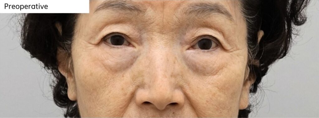 Preoperative appearance before lower blepharoplasty in a patient in her 70s showing lower eyelid bulging and volume imbalance