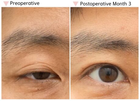 Can Epicanthoplasty Leave a Visible Scar?