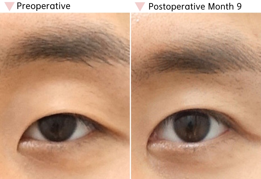 Before and after epicanthoplasty correction at 9 months showing improved inner corner definition, increased eye width, and stable long-term results.