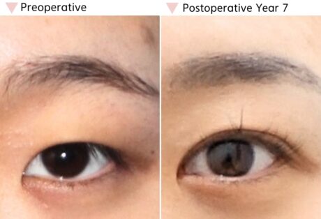 Why Do My Eyes Look Smaller After Eyelid Surgery?