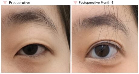 Who Is a Good Candidate for Epicanthoplasty?