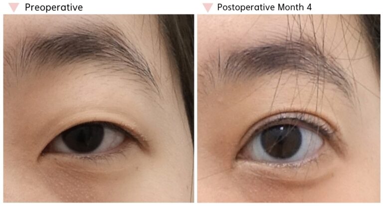 Before and after epicanthoplasty with ptosis correction showing a naturally opened inner corner and improved eye balance at 4 months after surgery.