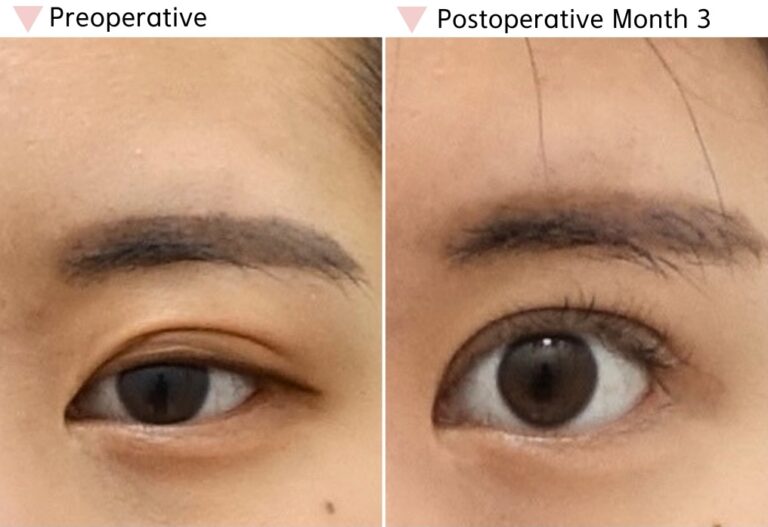 Before and after epicanthoplasty and ptosis correction at 3 months showing improved eye opening and inner corner definition.