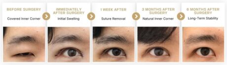 Epicanthoplasty Recovery Timeline: What to Expect.