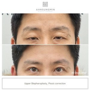 Ptosis correction