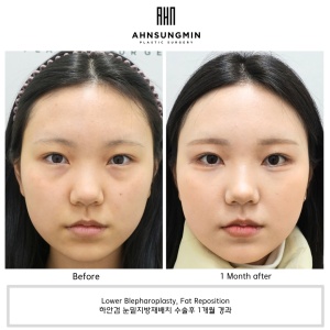 Lower Blepharoplasty
