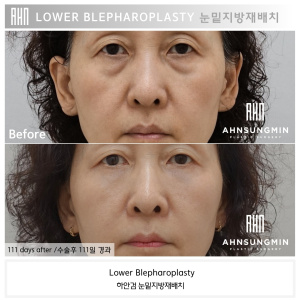 Lower Blepharoplasty