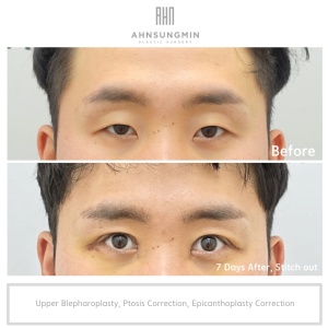 Ptosis correction