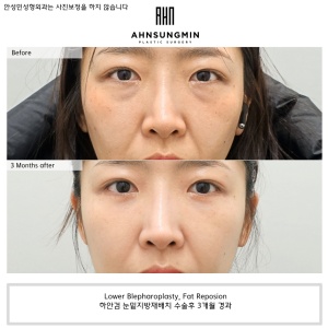 lower eyelid surgery
