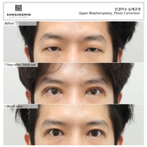 ptosis correction 