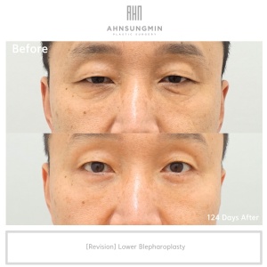 [Revision case]Lower Blepharoplasty