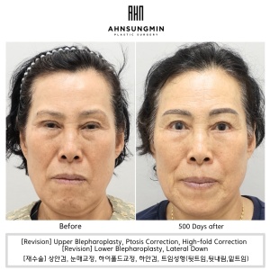 [Revision] ptosis correction surgery for middle-aged woman