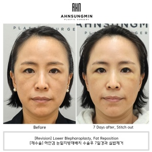 [Revision case] Lower Blepharoplasty