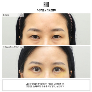Ptosis Correction