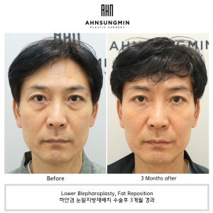Lower eyelid surgery for middle-aged men
