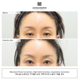 [Revision] ptosis correction surgery for woman