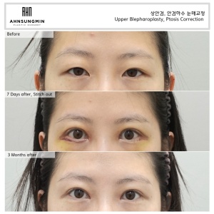 ptosis correction surgery