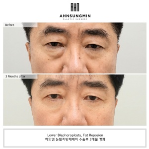 Lower eyelid surgery for middle-aged men
