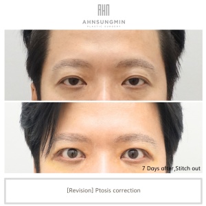 Revision Ptosis Correction