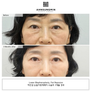 lower eyelid surgery