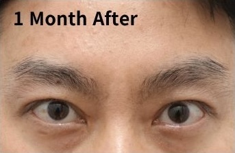 1 month after eyelid revision showing improved eyelid opening and structural balance