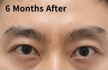 6 months after eyelid revision showing stable and natural eyelid position