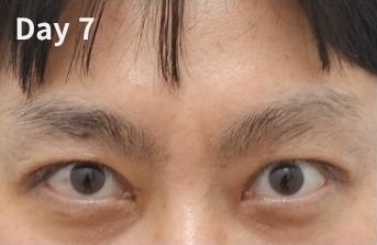 Day 7 after eyelid revision showing reduced swelling and improving eyelid function