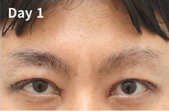 Day 1 after eyelid revision with visible swelling and early healing changes