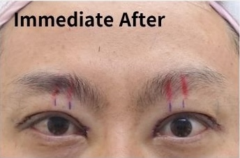 Immediate postoperative eyelid after high fold revision and ptosis correction with swelling and surgical markings