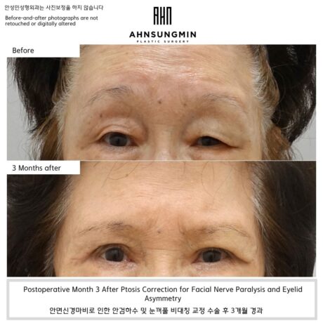 Ptosis Correction for Facial Nerve Paralysis and Eyelid Asymmetry.