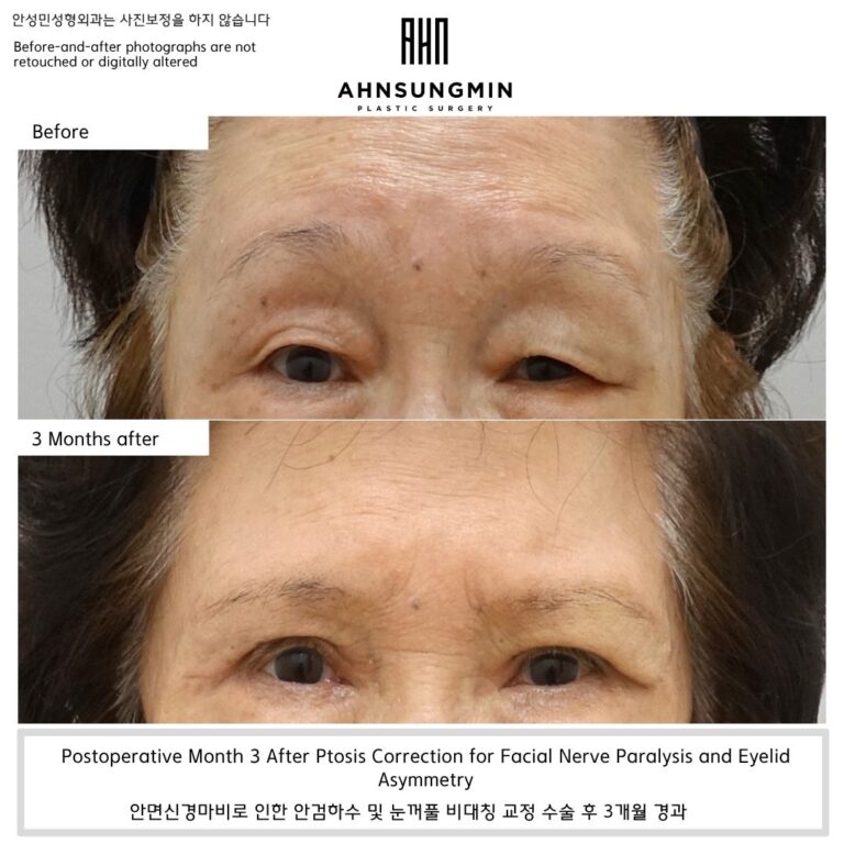 Ptosis Correction for Facial Nerve Paralysis and Eyelid Asymmetry.