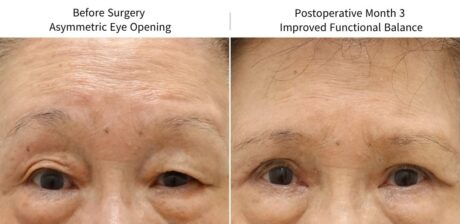 Why Eyelid Movement Matters When Evaluating Ptosis and Asymmetry