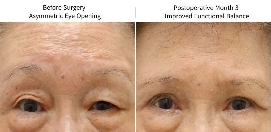 Functional eye opening before and 3 months after ptosis correction for facial nerve paralysis and eyelid asymmetry