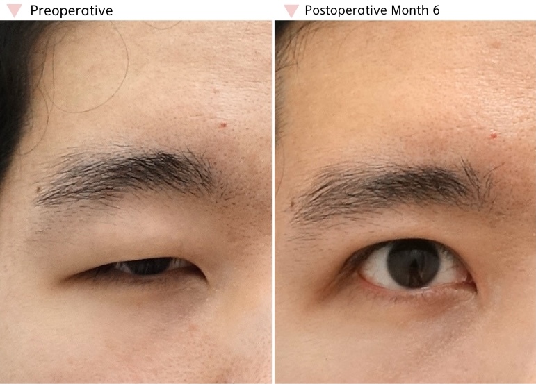 Before and 6 months after functional ptosis correction showing improved eyelid opening and more stable eye balance.