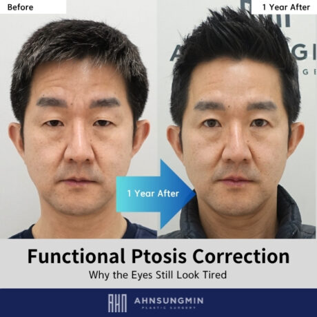 Why Do Eyes Look Uneven After Ptosis Surgery? (Recovery Explained)