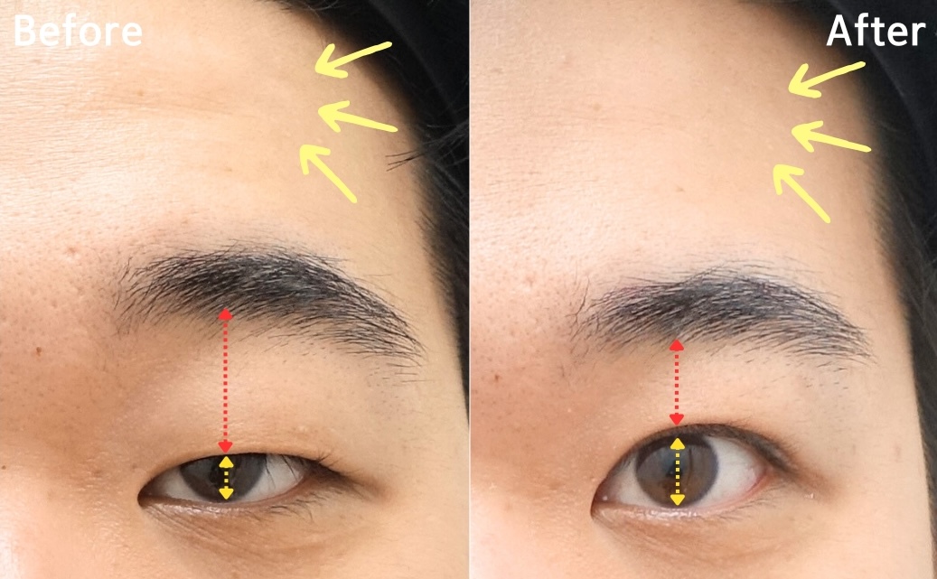 Functional ptosis correction before and after showing reduced compensatory brow elevation and improved eyelid opening