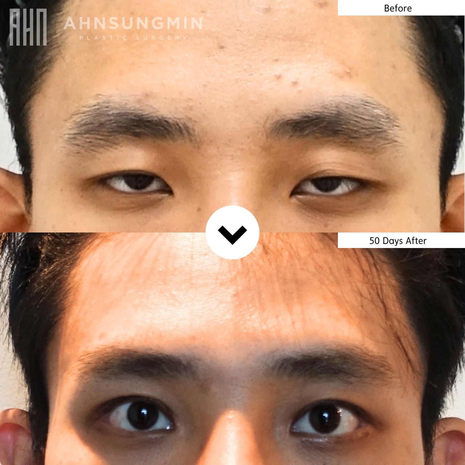 Functional ptosis correction in Korea before and 50 days after surgery showing reduced compensatory brow use
