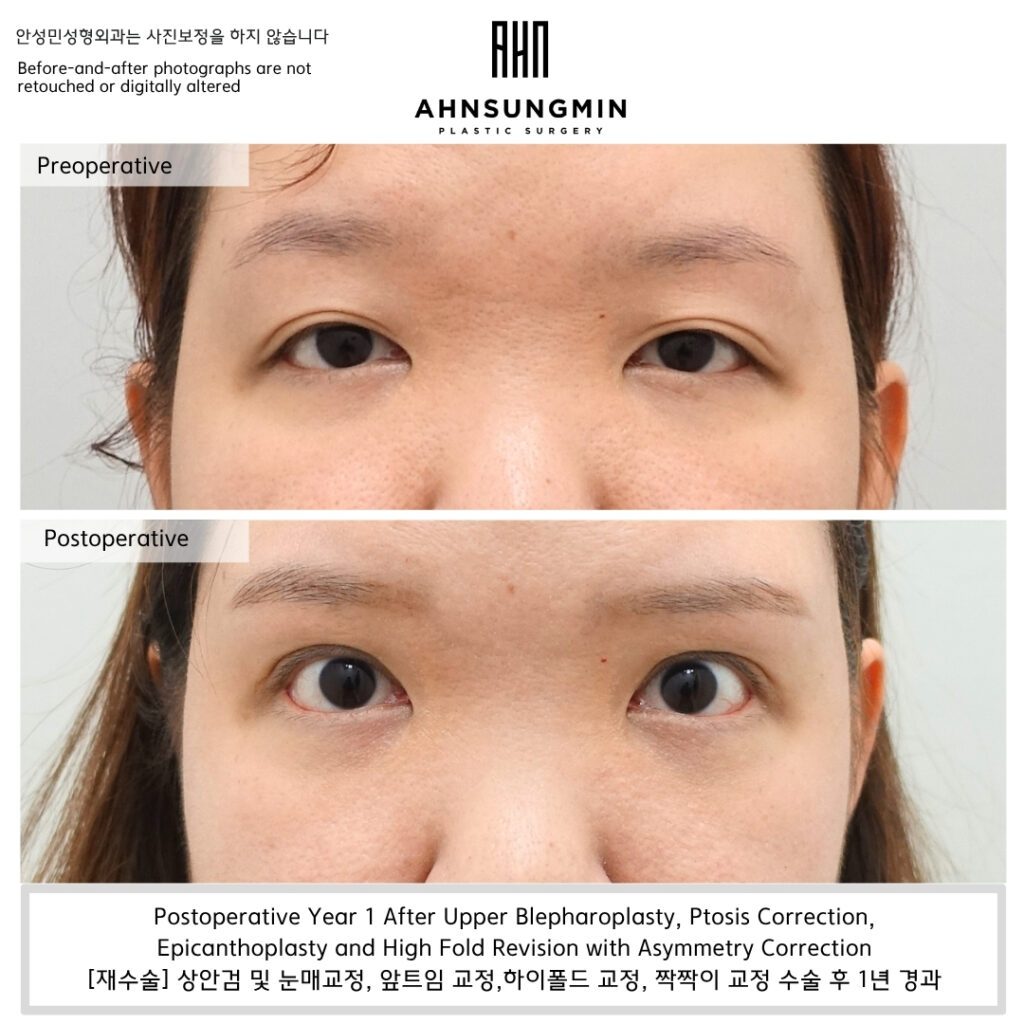 heavy eyes after double eyelid surgery ptosis correction revision before after
