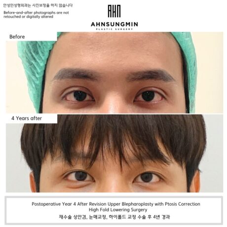 Four Years After Revision Eyelid Surgery: Restoring a More Natural Masculine Appearance.