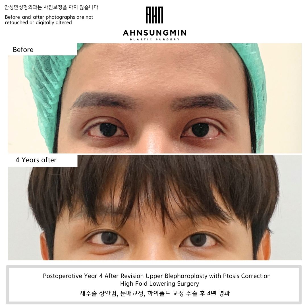 High Fold Correction Before and After 4 Years – Revision Upper Blepharoplasty with Ptosis Correction