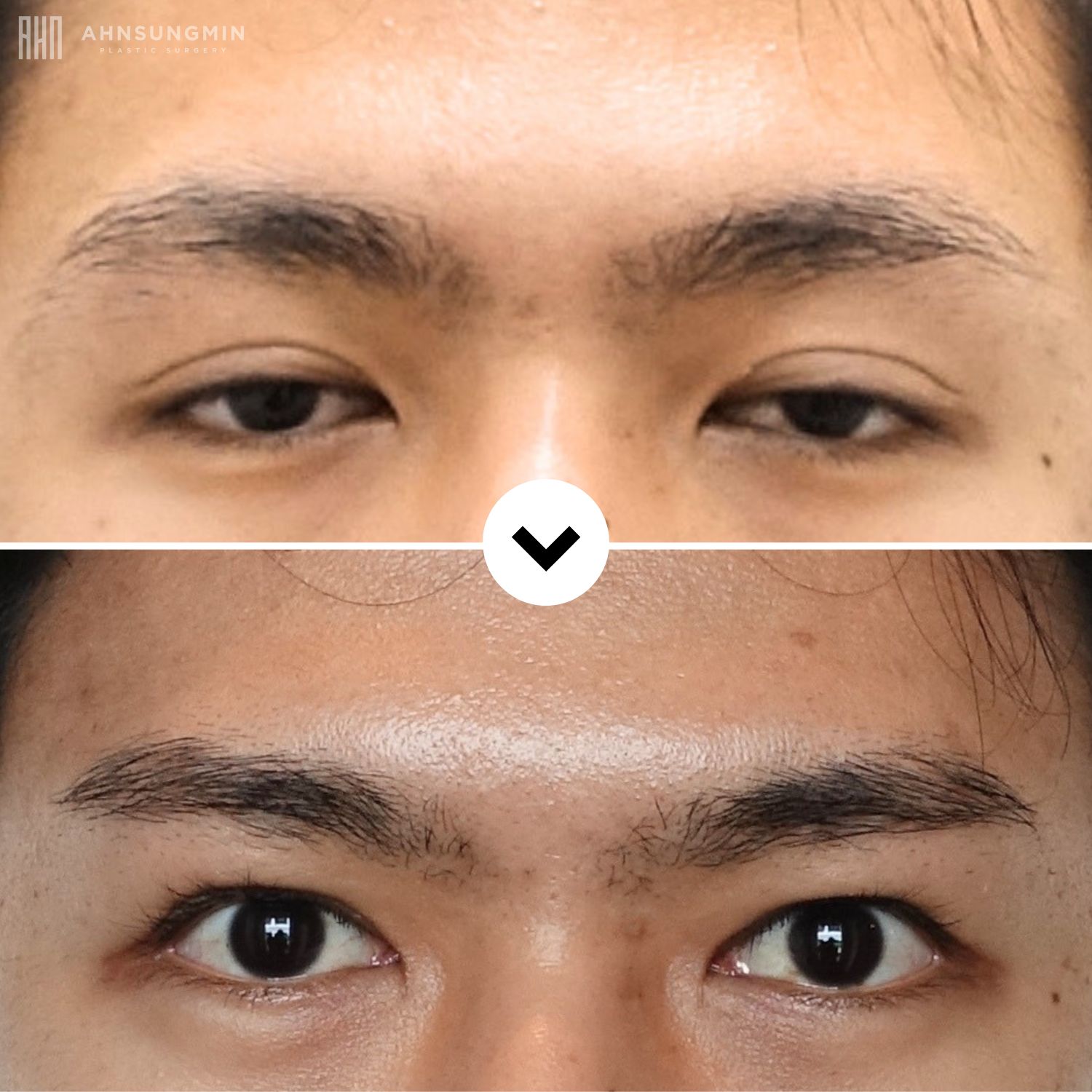 Before and after high fold correction in Korea showing a lower, more natural double eyelid crease and improved eyelid balance.