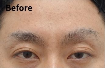 Before eyelid revision showing high fold and limited eyelid opening due to ptosis