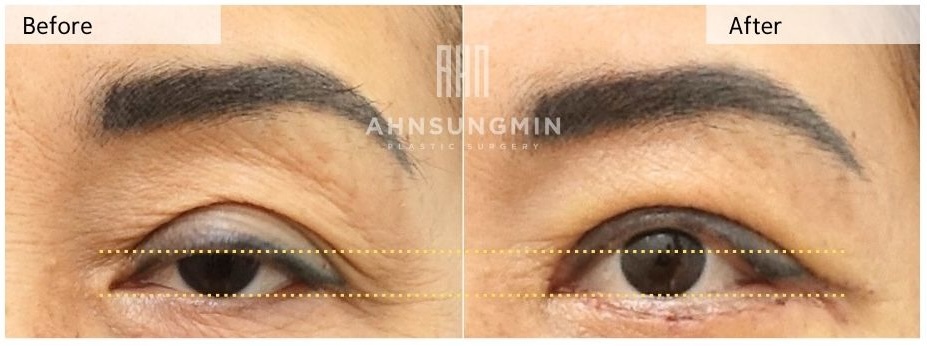 high fold eyelid corrected with ptosis surgery before and after comparison