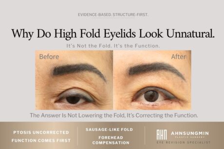 Why Do High Fold Eyelids Look Unnatural.