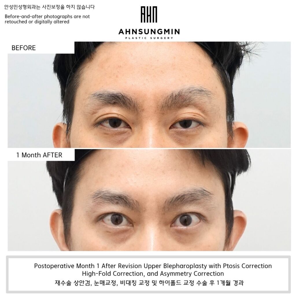 Male patient before and 1 month after high fold eyelid revision with ptosis correction showing improved eyelid opening and symmetry