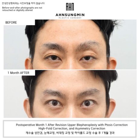 Why Do My Eyes Look Uneven After Double Eyelid Surgery.