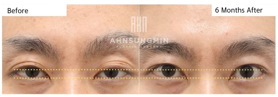 high fold eyelid revision with ptosis correction line comparison before and after 6 months